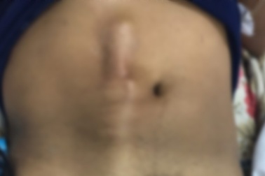 Cứu sống bệnh nhân bị cây dài nửa mét đâm thủng bụng