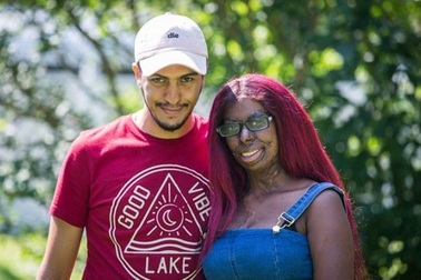 Tình yêu ngọt ngào của cô gái mang sẹo bỏng toàn thân từng bị gọi là "quái vật"