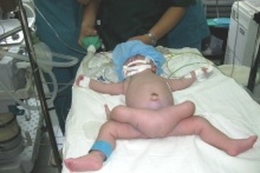 Em bé 4 chân đã được tách bỏ “chân thừa”