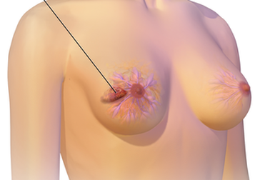 Nổi hạch nách- khi nào là dấu hiệu cảnh báo ung thư?