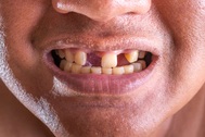 Các nhà khoa học tìm ra cách có thể giúp con người mọc lại răng
