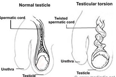 Xoắn tinh hoàn - chậm là “chết”