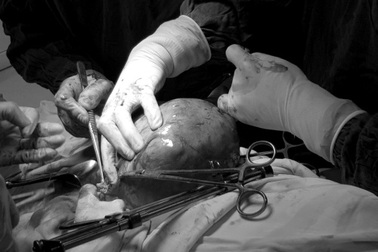 Người phụ nữ 35 tuổi nguy kịch vì sai lầm nhiều người thường mắc khi điều trị u xơ