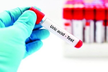 5 cách tự nhiên giúp giảm axit uric, ngăn ngừa bệnh gút tại nhà