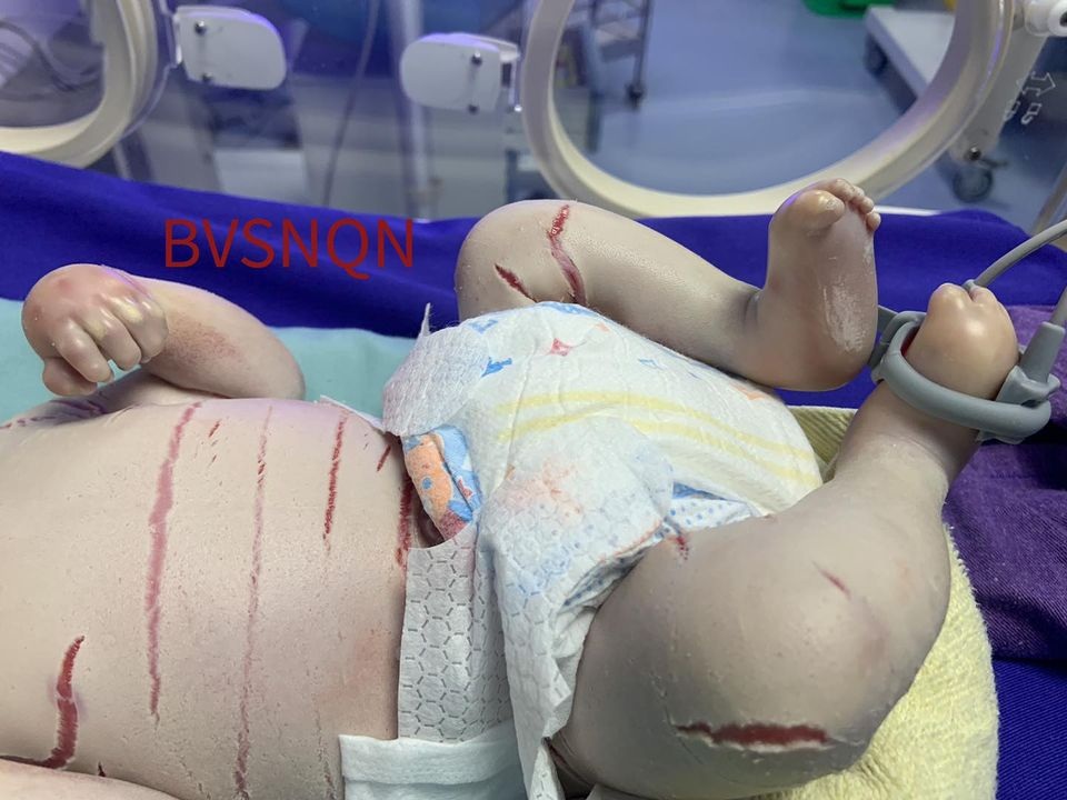 Bé trai sinh non mắc bệnh hiếm gặp, màng trắng bao bọc toàn thân - 2 Bé trai sinh non mắc bệnh hiếm gặp, màng trắng bao bọc toàn thân - 2