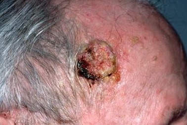 Thuốc lợi tiểu thiazide có thể làm tăng nguy cơ ung thư da