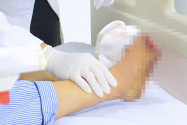 Người phụ nữ gánh hậu quả nặng nề khi ngâm chân vào chậu nước nóng