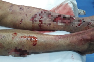 Cụ ông 93 tuổi bị chó nhà cắn nát chân