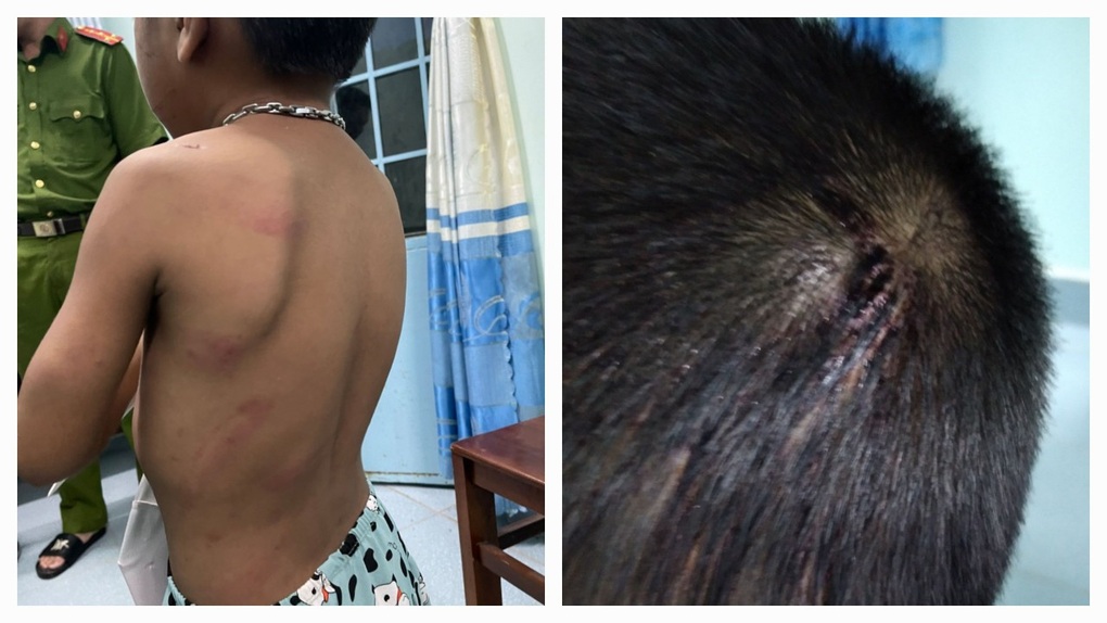 Bắt giam người cha dùng thanh sắt đánh vào đầu con trai 6 tuổi - 2 Bắt giam người cha dùng thanh sắt đánh vào đầu con trai 6 tuổi - 2