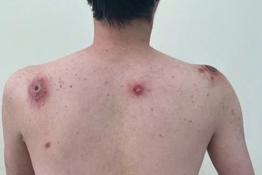 Xuất hiện nhiều vết loét trên lưng sau lần "vượt rào" không an toàn