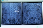 Thách thức tán sỏi san hô khổng lồ cho bệnh nhân hậu tai biến