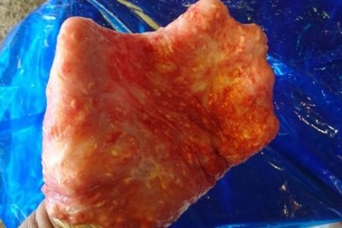 Dùng ruột cá "tự sướng", chàng trai đau đớn nhập viện