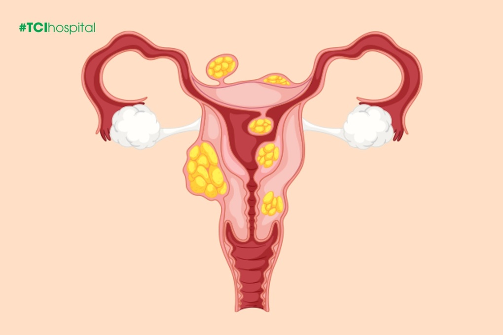 Bệnh nhân 50 tuổi vượt hàng trăm cây số chữa u xơ tử cung - 4 Bệnh nhân 50 tuổi vượt hàng trăm cây số chữa u xơ tử cung - 4