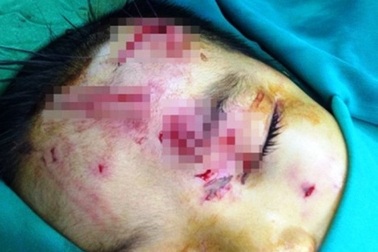 Bị chó nhà tấn công, bé trai 7 tuổi nguy kịch