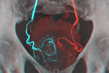 Điều trị u xơ tuyến tiền liệt không phải phẫu thuật