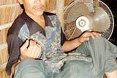 Khối u hơn 25kg ở bộ phận sinh dục