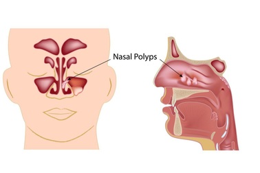 Polyp mũi: Triệu chứng và cách phòng ngừa