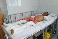 Người đàn ông bị điện phóng cụt 2 tay nghẹn ngào: "Mọi người đừng như tôi"