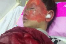 Học sinh lớp 2 bỏng nặng do nghịch pháo