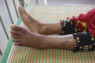 Quảng Ngãi: Lo ngại vì "bệnh lạ" dày sừng tái phát diện rộng