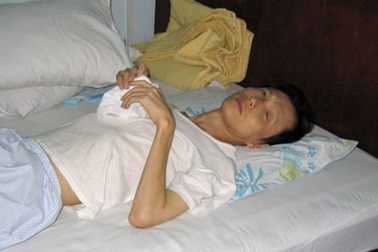 Số phận nghiệt ngã của bác sĩ nhãn khoa bị ung thư mắt