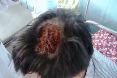 Vụ vây bắt lâm tặc: Lời kể của kiểm lâm bị đánh trọng thương