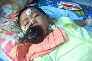 Quỹ Nhân ái hỗ trợ khẩn 5 triệu đồng đến bé Lê Minh Huy