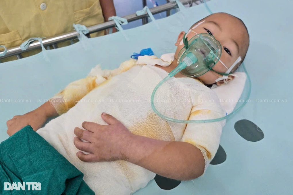 Ngã vào nồi cám lợn nóng, bé 3 tuổi dân tộc Mông bỏng 48% cơ thể - 2 Ngã vào nồi cám lợn nóng, bé 3 tuổi dân tộc Mông bỏng 48% cơ thể - 2