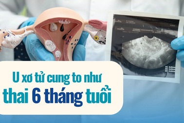 Tưởng béo bụng, người phụ nữ mang khối u như thai 6 tháng suốt nhiều năm