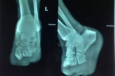 Đạp vỏ ốc, bệnh nhân tiểu đường phải tháo khớp bàn chân