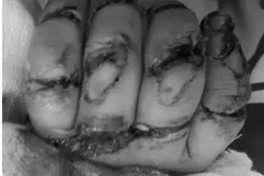 Bệnh nhi 23 tháng tuổi suýt mất 5 ngón tay vì máy rửa xe