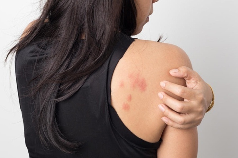 Những vết mẩn đỏ cảnh báo căn bệnh ung thư phổ biến - 1 Những vết mẩn đỏ cảnh báo căn bệnh ung thư phổ biến - 1