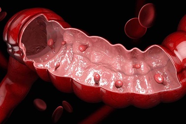 Ngăn ngừa polyp ung thư hóa như thế nào?