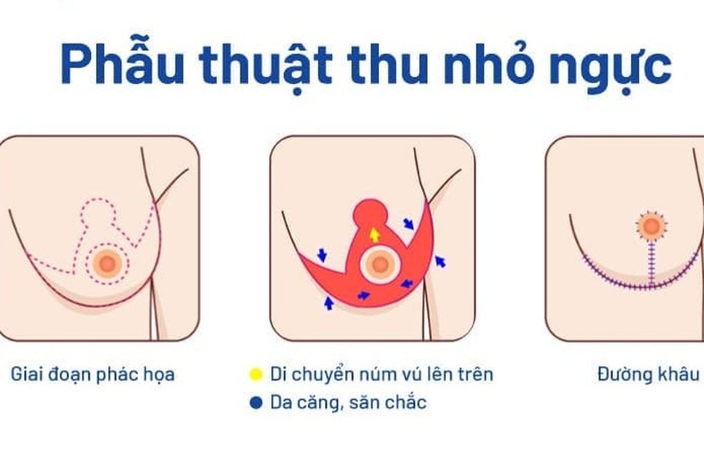 TPHCM: Người phụ nữ khó thở, đau mỏi vai cổ suốt 10 năm vì bộ ngực khủng - 2