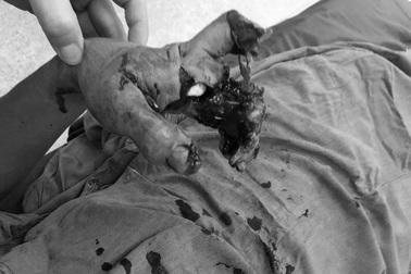 Thêm nhiều nạn nhân bị nổ mắt, cụt tay vì chơi pháo ngày Tết