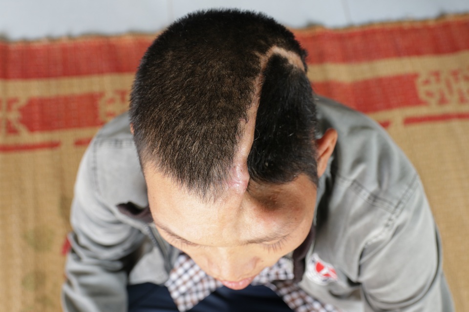 Thương người phụ nữ bán rau, chồng mất tích, con trai sống với nửa hộp sọ - 2 Thương người phụ nữ bán rau, chồng mất tích, con trai sống với nửa hộp sọ - 2