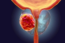 Loại thuốc mới tiếp thêm hy vọng cho bệnh nhân ung thư tuyến tiền liệt