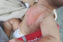 Bị nước sôi đổ lên người, bé 2 tuổi bỏng nặng