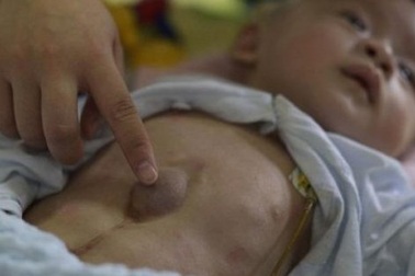 Em bé có tim ngoài cơ thể bị bỏ rơi ở Trung Quốc