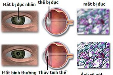Dư luận gay gắt trước vụ việc ở bệnh viện Mắt Hà Nội