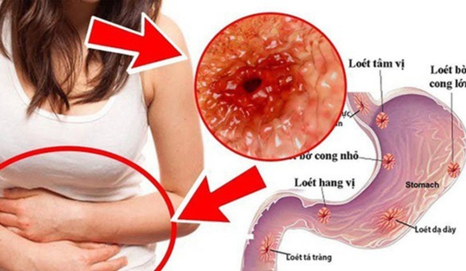 Các giai đoạn của ung thư dạ dày - 1 Các giai đoạn của ung thư dạ dày - 1