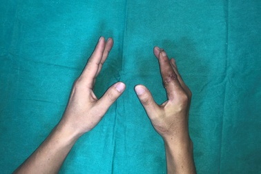 Lần đầu tiên tại Việt Nam, ngón tay đứt rời 25 giờ được nối thành công