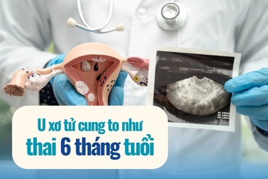 Tưởng béo bụng, người phụ nữ mang khối u như thai 6 tháng suốt nhiều năm