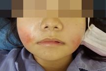 Má đỏ rực như hai quả cà chua sau khi tiêm filler giảm nếp nhăn tại spa