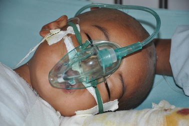 Ngã vào nồi cám lợn, bé 4 tuổi nguy kịch tính mạng