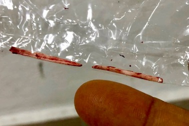 Xương cá "đi lạc" vào gan người đàn ông