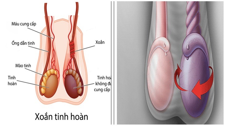 Cơn đau bìu tưởng bình thường nhưng là cấp cứu tối khẩn cấp - 1