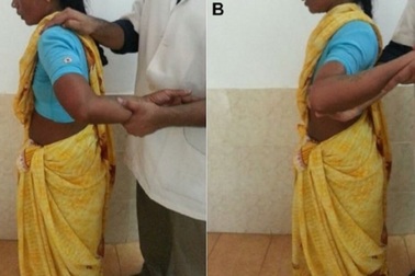Một phụ nữ Ấn độ có thể xoay cánh tay 180 độ