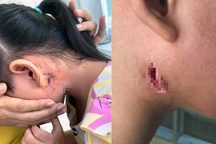 Một bệnh nhân tử vong vì nhiễm "vi khuẩn ăn thịt"