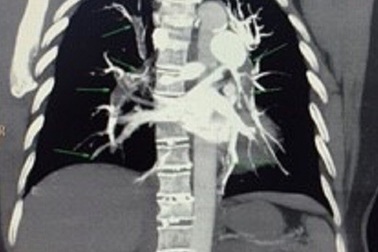 Nguy kịch vì nguyên cả “cây” máu đông trong hệ mạch sau cắt tử cung